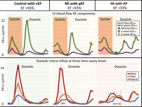 lv ke|Left ventricular blood flow kinetic energy after myocardial .